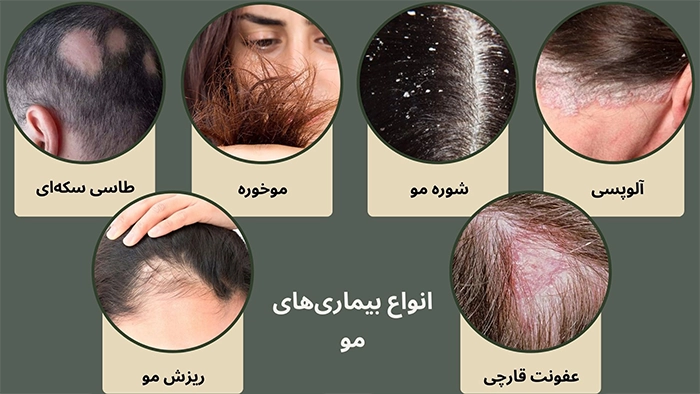 انواع بیماری های مو