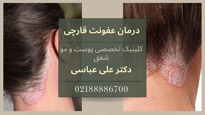 درمان عفونت قارچی مو