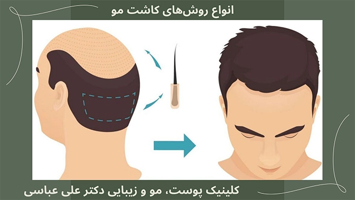 انواع روش های کاشت مو