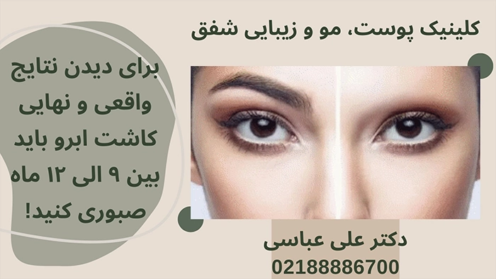 نتیجه نهایی کاشت ابرو