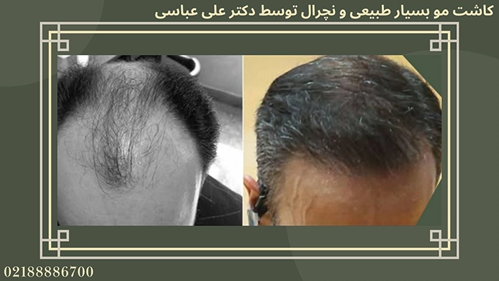 نمونه کاشت مو دکتر عباسی ۱