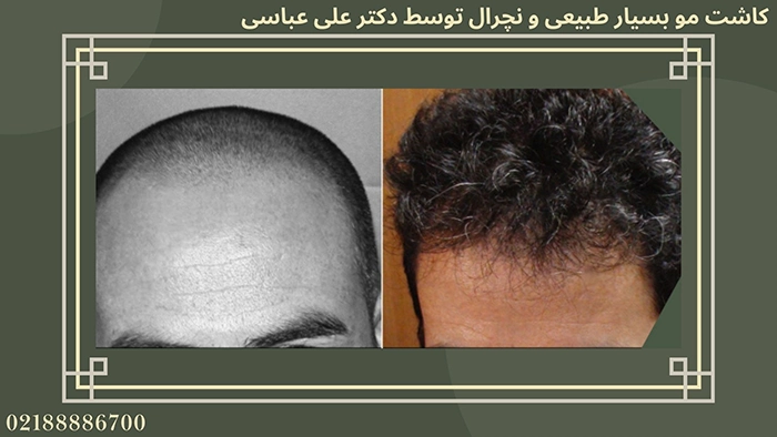 نمونه کاشت مو کلینیک شفق