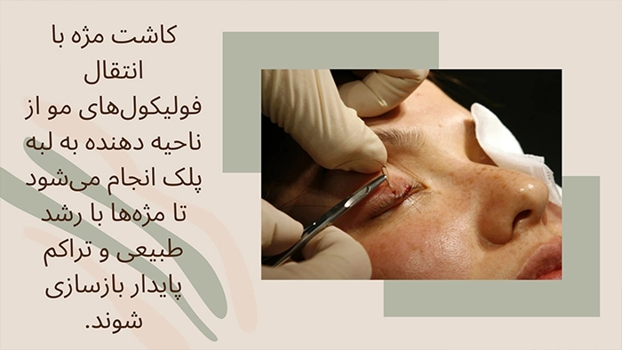 جراحی کاشت مژه
