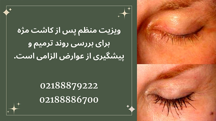 ویزیت بعد از کاشت مژه