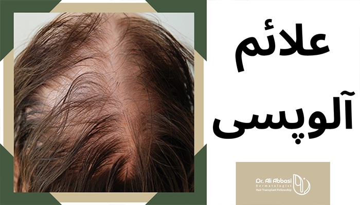 علائم آلوپسی