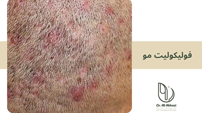فولیکولیت مو