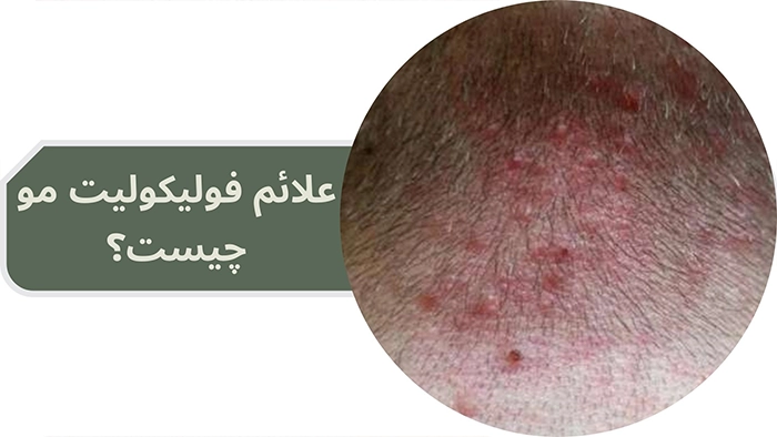 علائم فولیکولیت مو