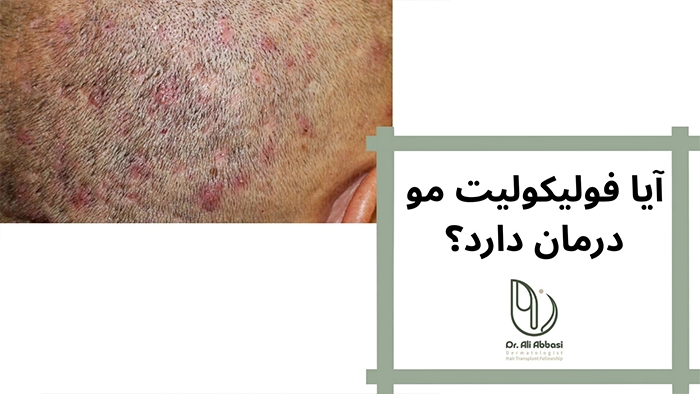 درمان فولیکولیت مو