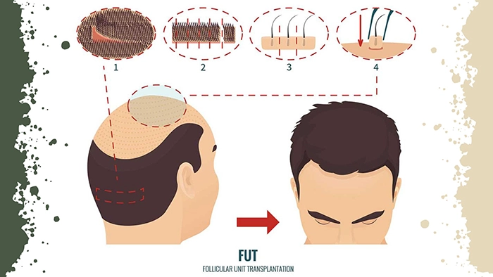 کاشت مو به روش FUT