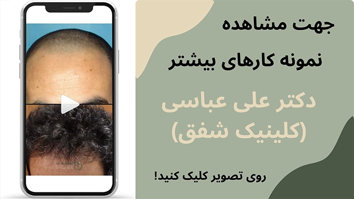 نمونه کاشت مو به روش FUT